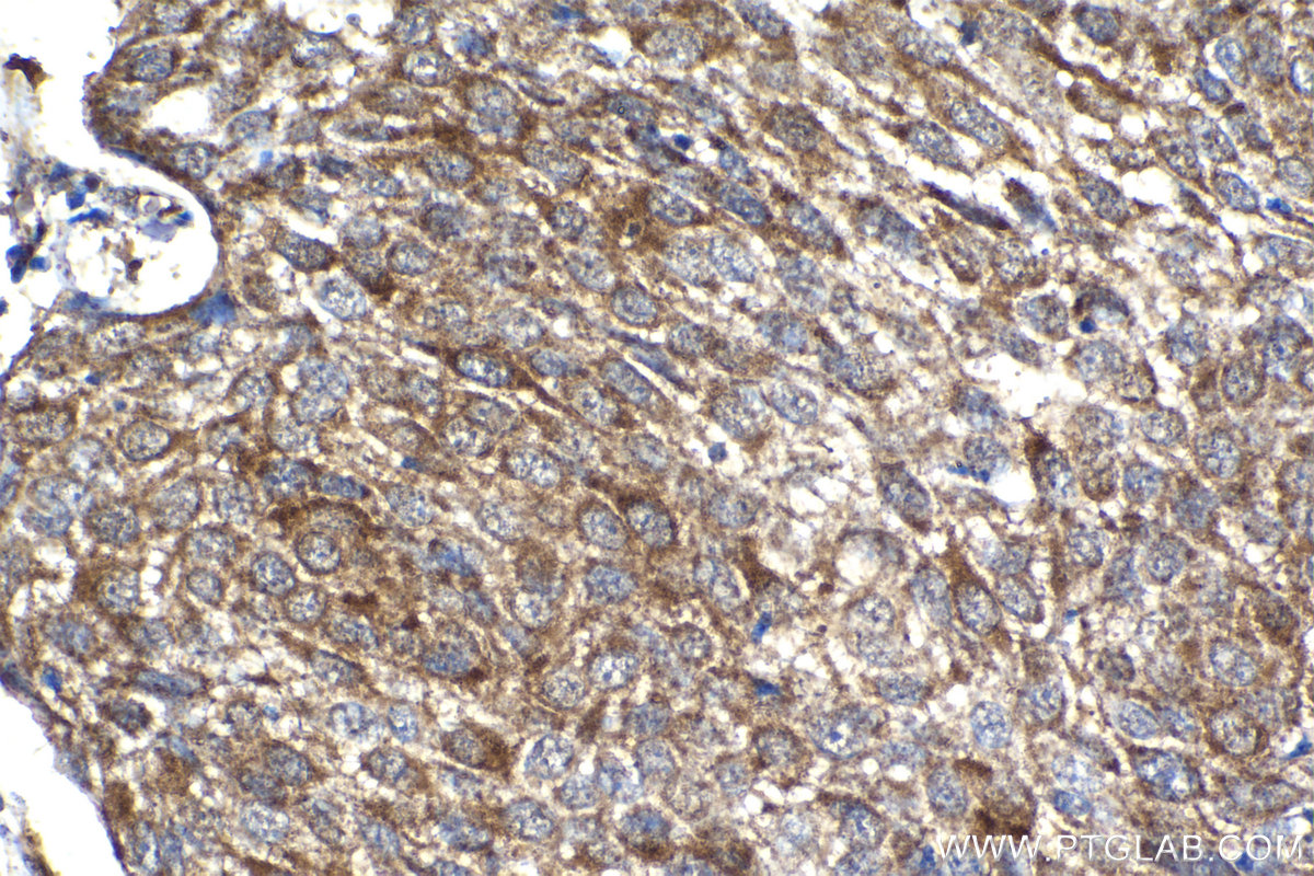 Immunohistochemistry (IHC) staining of human cervical cancer tissue using BubR1 Polyclonal antibody (11504-2-AP)