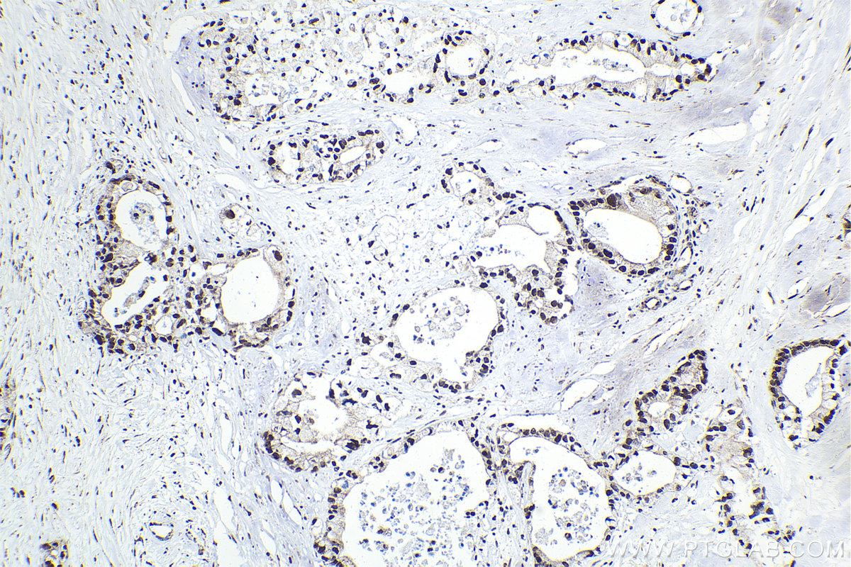 Immunohistochemistry (IHC) staining of human pancreas cancer tissue using BUB3 Polyclonal antibody (27073-1-AP)