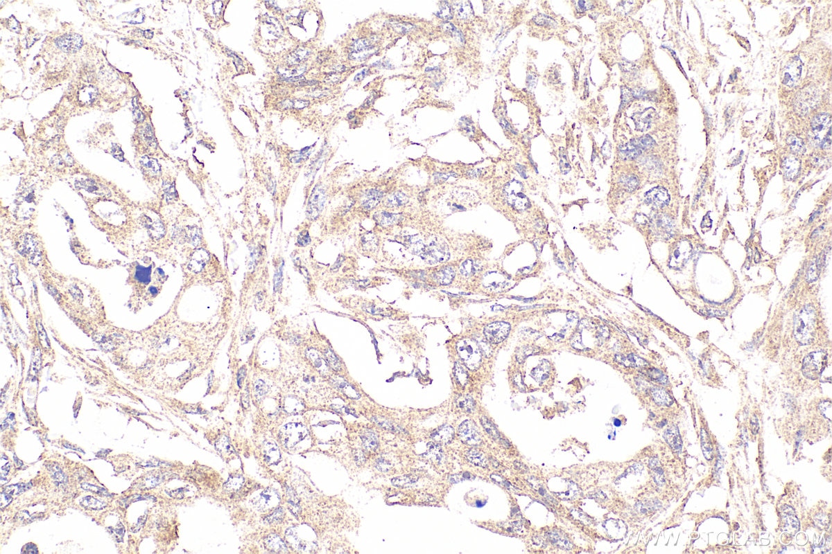 Immunohistochemistry (IHC) staining of human colon cancer tissue using Beclin 1 Monoclonal antibody (66665-1-Ig)