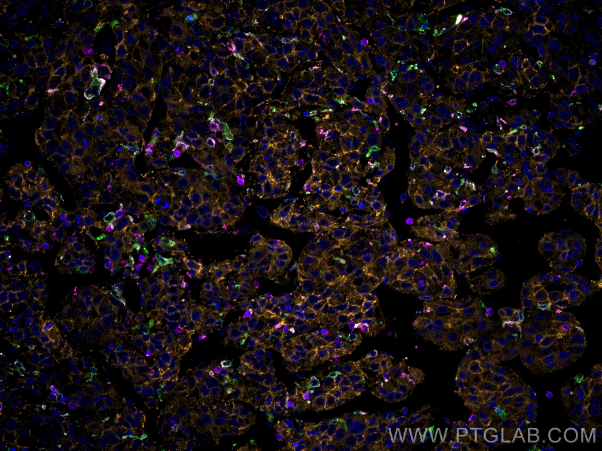 Immunofluorescence (IF) / fluorescent staining of human liver cancer tissue using CoraLite®555-conjugated Beta Catenin Polyclonal an (CL555-51067)