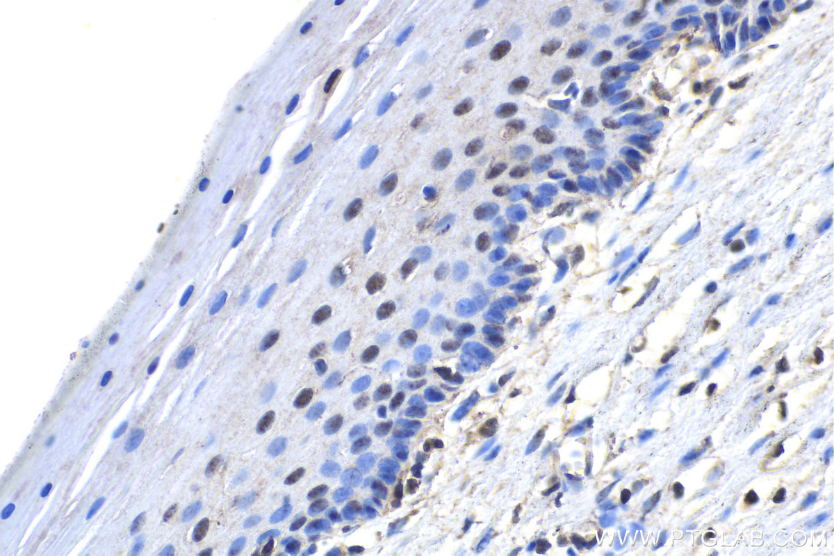 Immunohistochemistry (IHC) staining of human cervical cancer tissue using EDRF1 Polyclonal antibody (21883-1-AP)