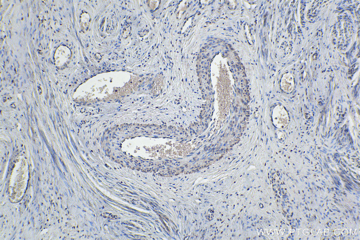 Immunohistochemistry (IHC) staining of human cervical cancer tissue using EDRF1 Polyclonal antibody (21883-1-AP)