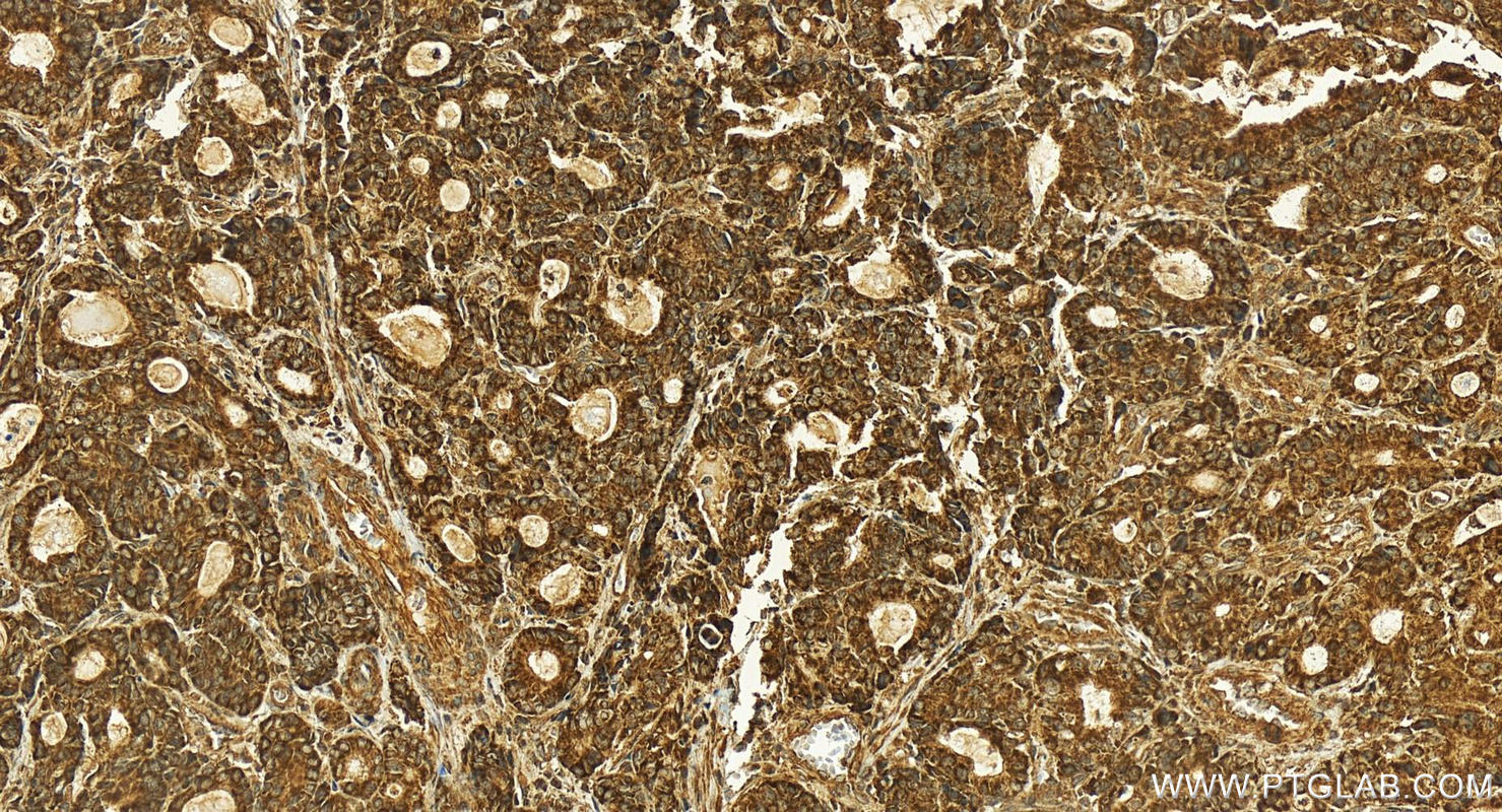 Immunohistochemistry (IHC) staining of human stomach cancer tissue using SLIRP Polyclonal antibody (26006-1-AP)