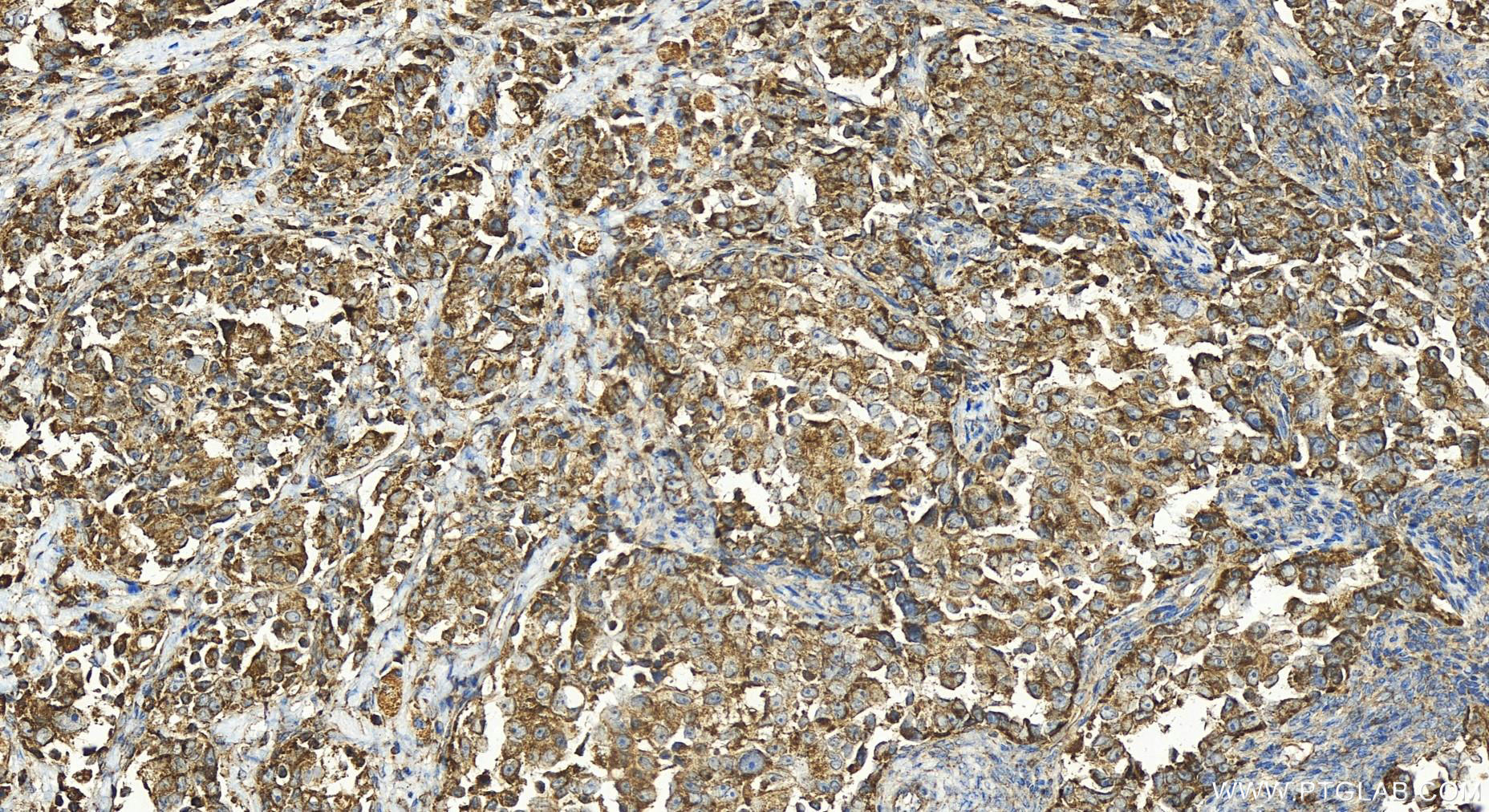 Immunohistochemistry (IHC) staining of human ovary cancer tissue using SLIRP Polyclonal antibody (26006-1-AP)