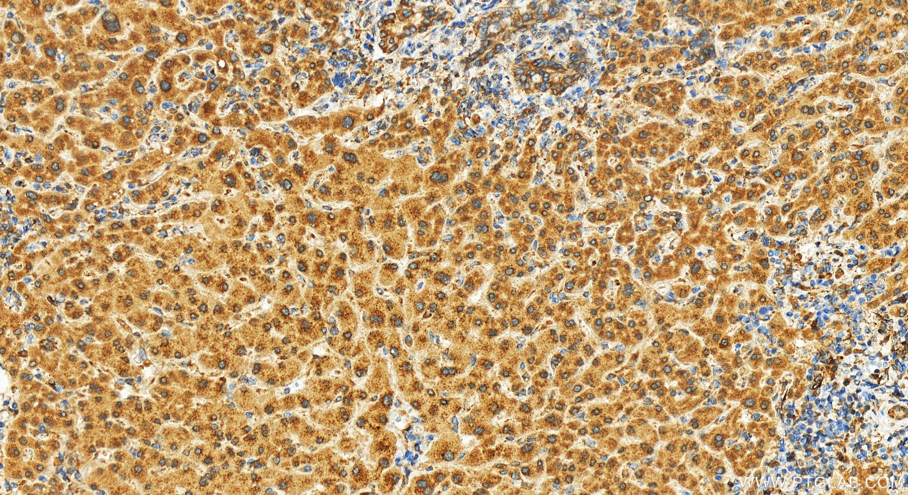 Immunohistochemistry (IHC) staining of human intrahepatic cholangiocarcinoma tissue using EMC7/C15orf24 Polyclonal antibody (27550-1-AP)