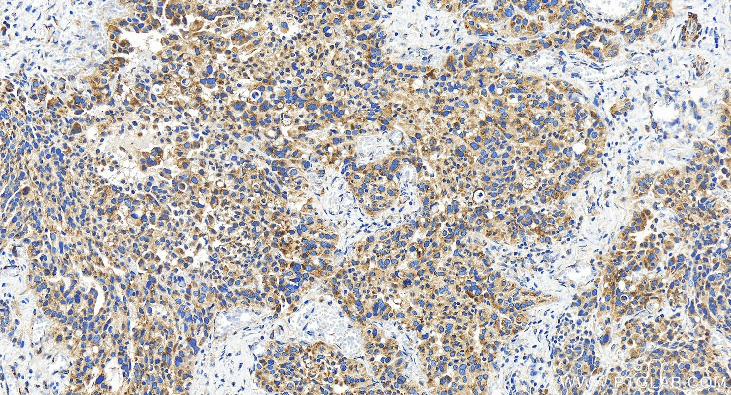 Immunohistochemistry (IHC) staining of human ovary cancer tissue using EMC7/C15orf24 Polyclonal antibody (27550-1-AP)