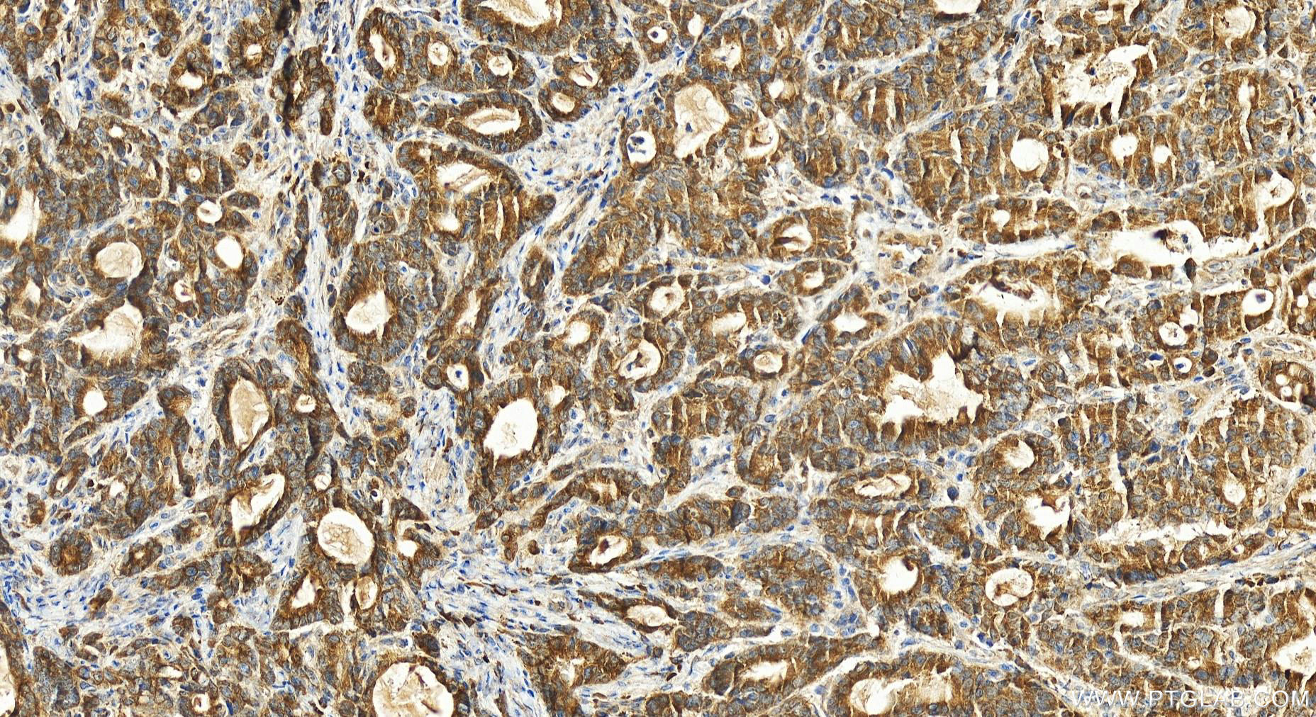 Immunohistochemistry (IHC) staining of human stomach cancer tissue using C17orf28 Polyclonal antibody (21174-1-AP)