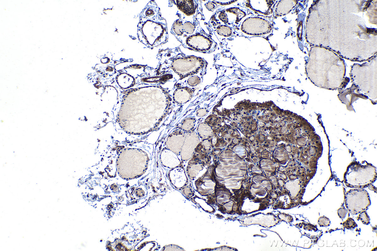 Immunohistochemistry (IHC) staining of human thyroid cancer tissue using C18orf21 Polyclonal antibody (24977-1-AP)