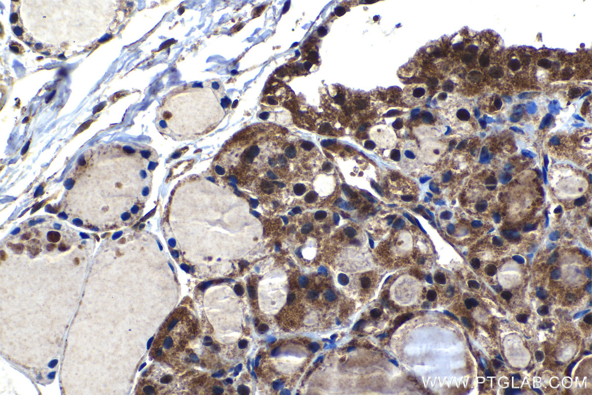 Immunohistochemistry (IHC) staining of human thyroid cancer tissue using C18orf21 Polyclonal antibody (24977-1-AP)