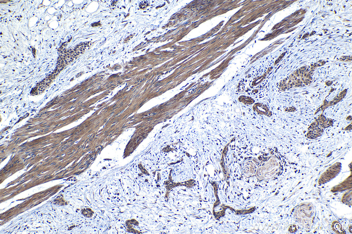 Immunohistochemistry (IHC) staining of human urothelial carcinoma tissue using C18orf21 Polyclonal antibody (24977-1-AP)