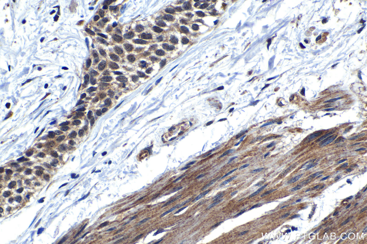 Immunohistochemistry (IHC) staining of human urothelial carcinoma tissue using C18orf21 Polyclonal antibody (24977-1-AP)