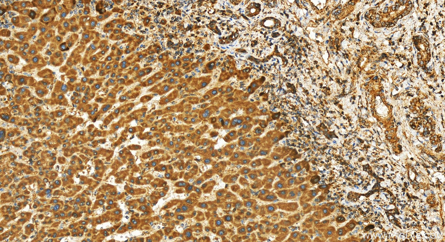 Immunohistochemistry (IHC) staining of human intrahepatic cholangiocarcinoma tissue using C19orf52 Polyclonal antibody (25652-1-AP)