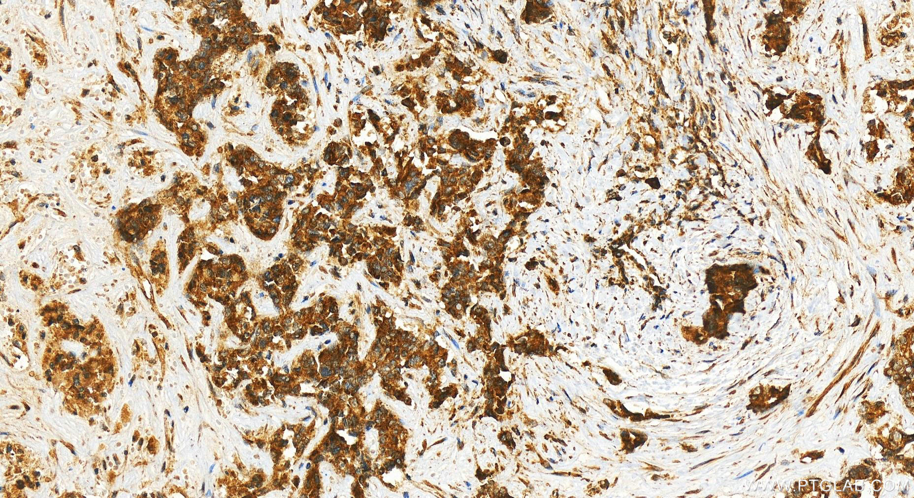 Immunohistochemistry (IHC) staining of human intrahepatic cholangiocarcinoma tissue using C19orf52 Polyclonal antibody (25652-1-AP)