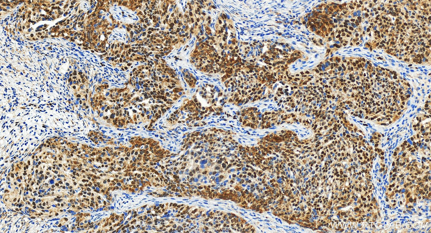 Immunohistochemistry (IHC) staining of human ovary cancer tissue using C20orf112 Polyclonal antibody (23746-1-AP)