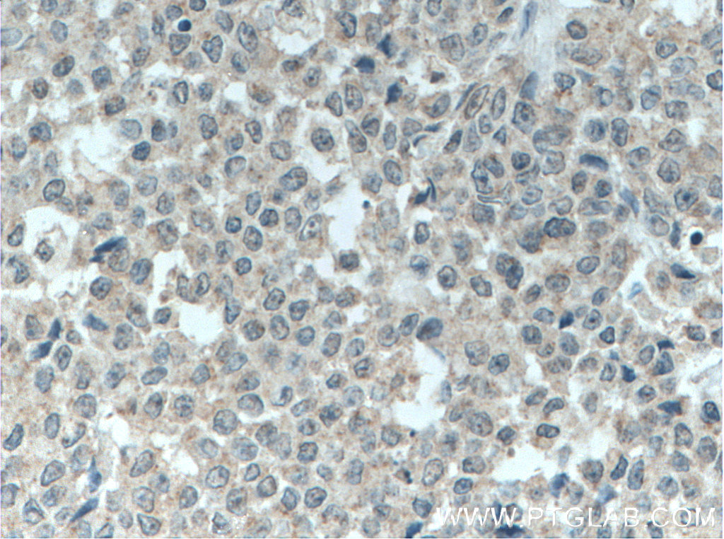 Immunohistochemistry (IHC) staining of human colon cancer tissue using PPDPF Polyclonal antibody (19912-1-AP)