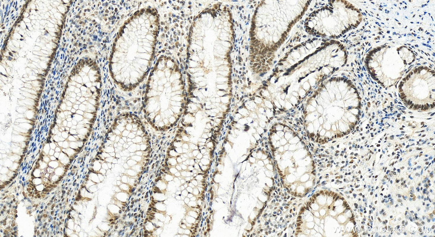 Immunohistochemistry (IHC) staining of human colon cancer tissue using C20orf20 Polyclonal antibody (26040-1-AP)