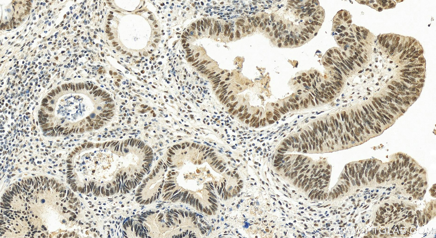 Immunohistochemistry (IHC) staining of human colon cancer tissue using C20orf20 Polyclonal antibody (26040-1-AP)