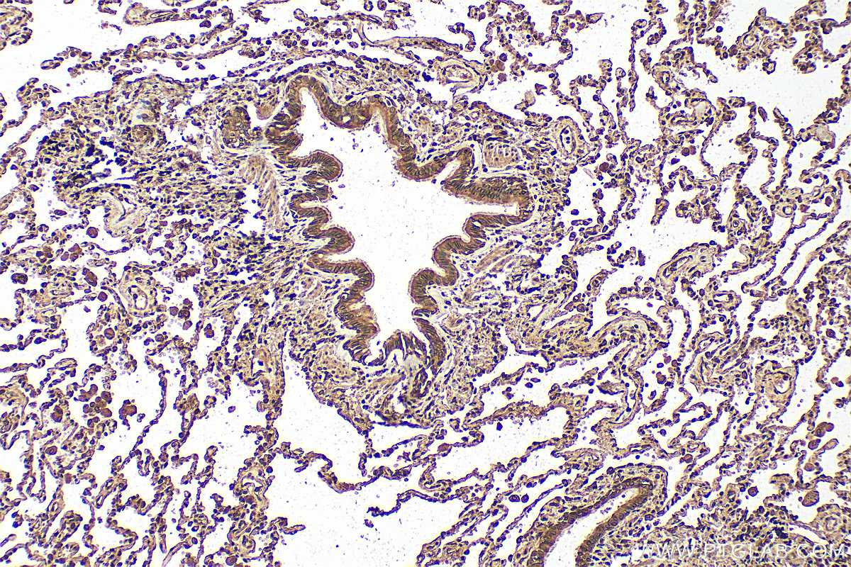 Immunohistochemistry (IHC) staining of human lung cancer tissue using C20orf3/APMAP Monoclonal antibody (67464-1-Ig)