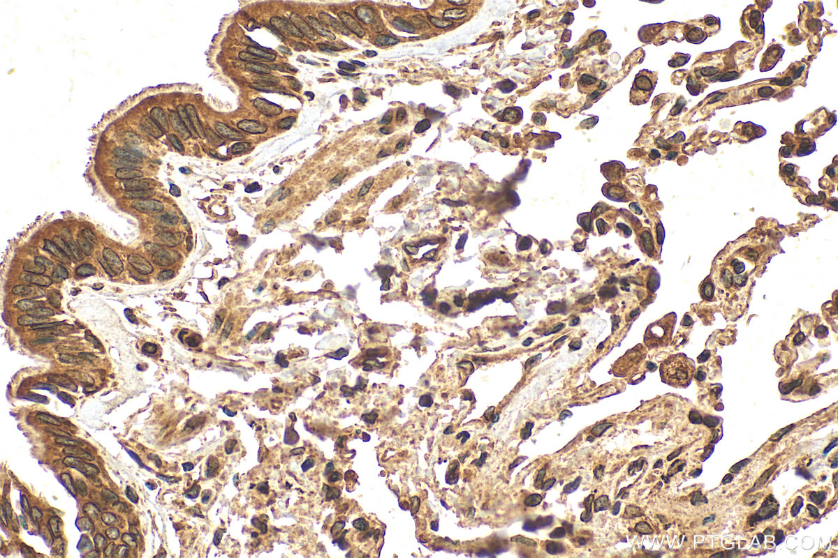 Immunohistochemistry (IHC) staining of human lung cancer tissue using C20orf3/APMAP Monoclonal antibody (67464-1-Ig)