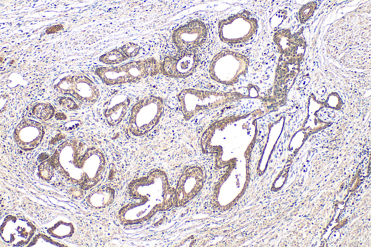 Immunohistochemistry (IHC) staining of human prostate cancer tissue using C20orf3/APMAP Monoclonal antibody (67464-1-Ig)