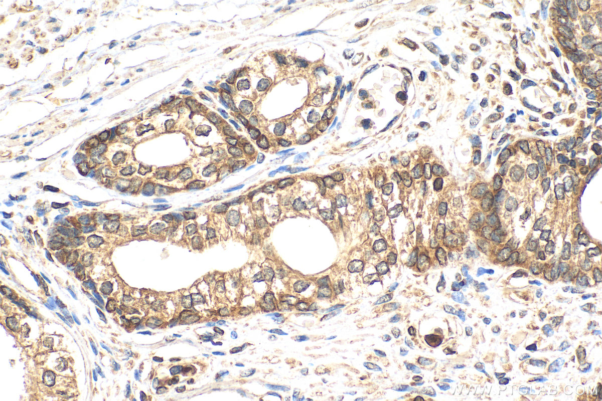 Immunohistochemistry (IHC) staining of human prostate cancer tissue using C20orf3/APMAP Monoclonal antibody (67464-1-Ig)