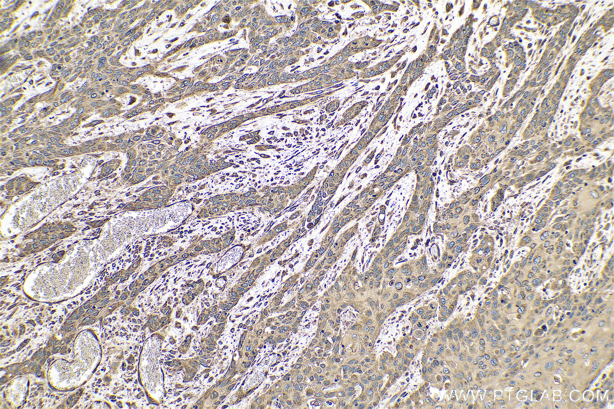 Immunohistochemistry (IHC) staining of human oesophagus cancer tissue using SLC52A3 Polyclonal antibody (25626-1-AP)