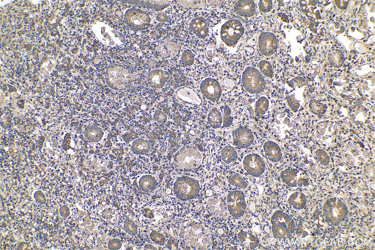 Immunohistochemistry (IHC) staining of human stomach cancer tissue using SLC52A3 Polyclonal antibody (25626-1-AP)