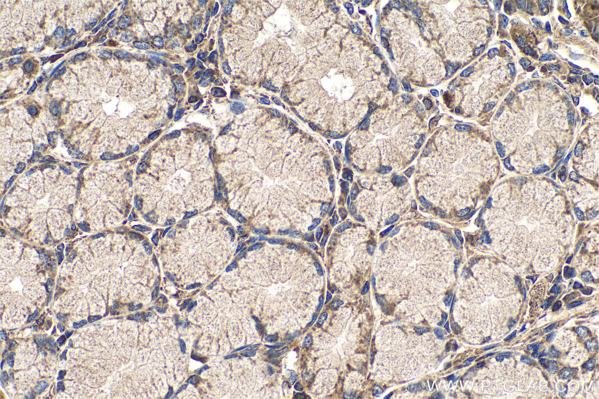 Immunohistochemistry (IHC) staining of human stomach cancer tissue using SLC52A3 Polyclonal antibody (25626-1-AP)