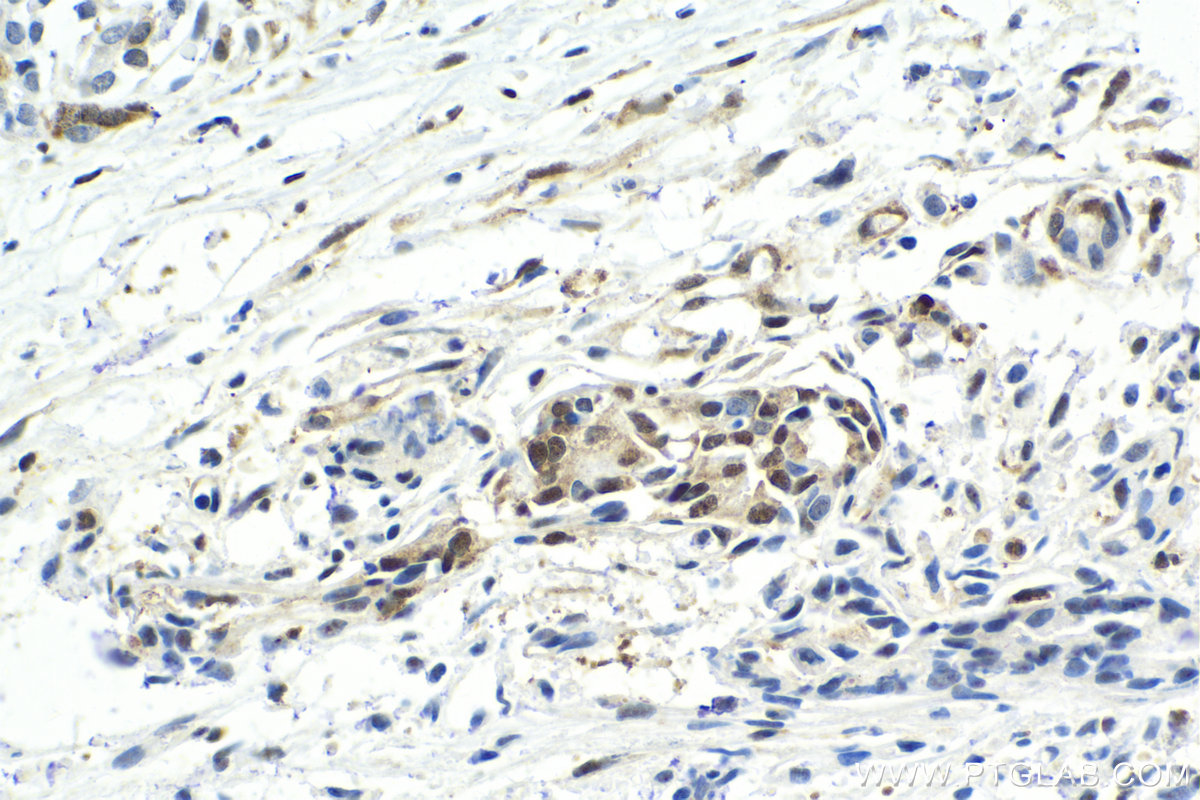 Immunohistochemistry (IHC) staining of human pancreas cancer tissue using C21orf66 Polyclonal antibody (21357-1-AP)