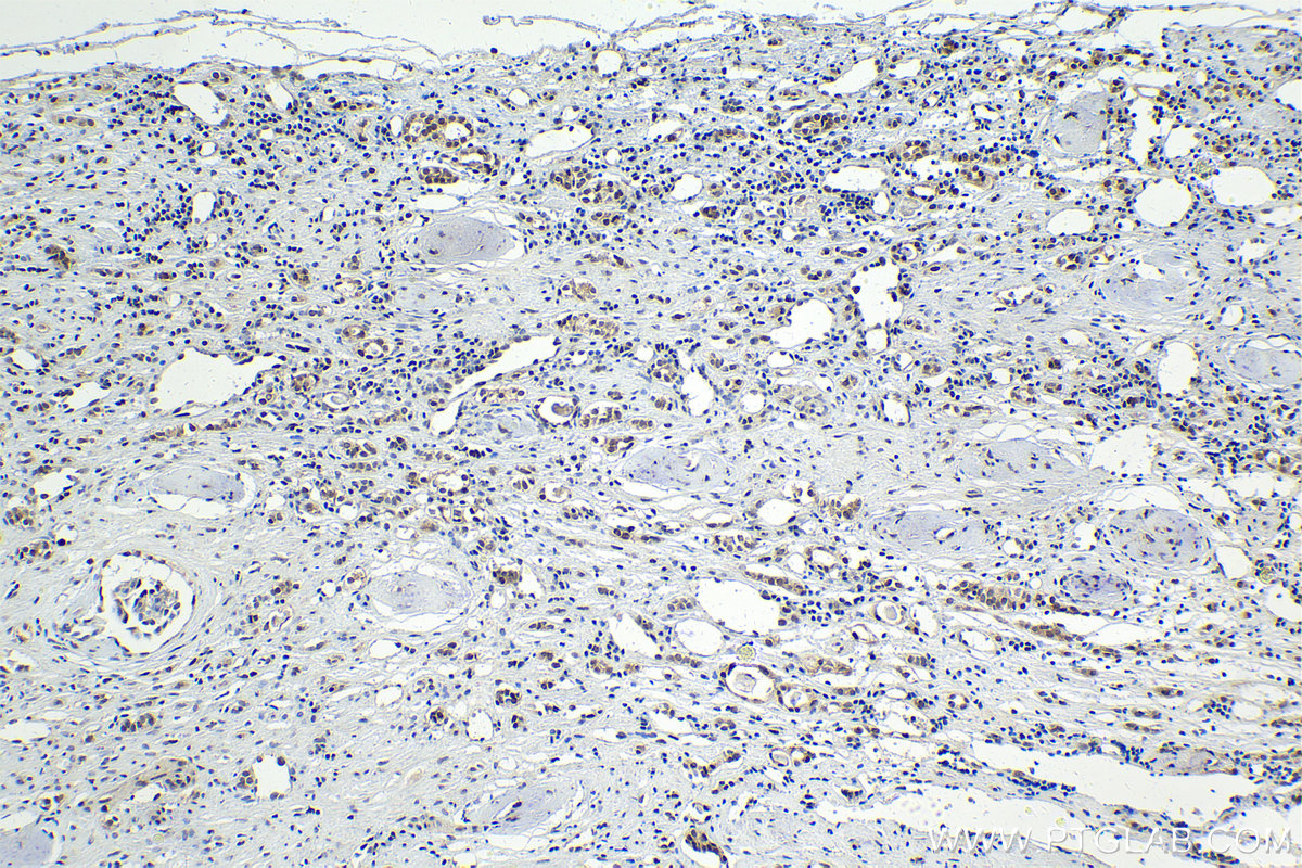 Immunohistochemistry (IHC) staining of human renal cell carcinoma tissue using C21orf66 Polyclonal antibody (21357-1-AP)