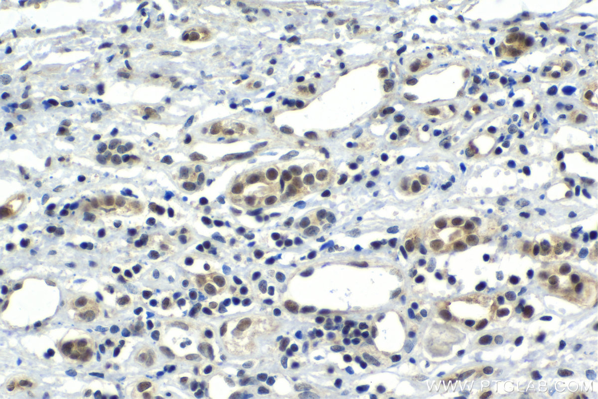 Immunohistochemistry (IHC) staining of human renal cell carcinoma tissue using C21orf66 Polyclonal antibody (21357-1-AP)