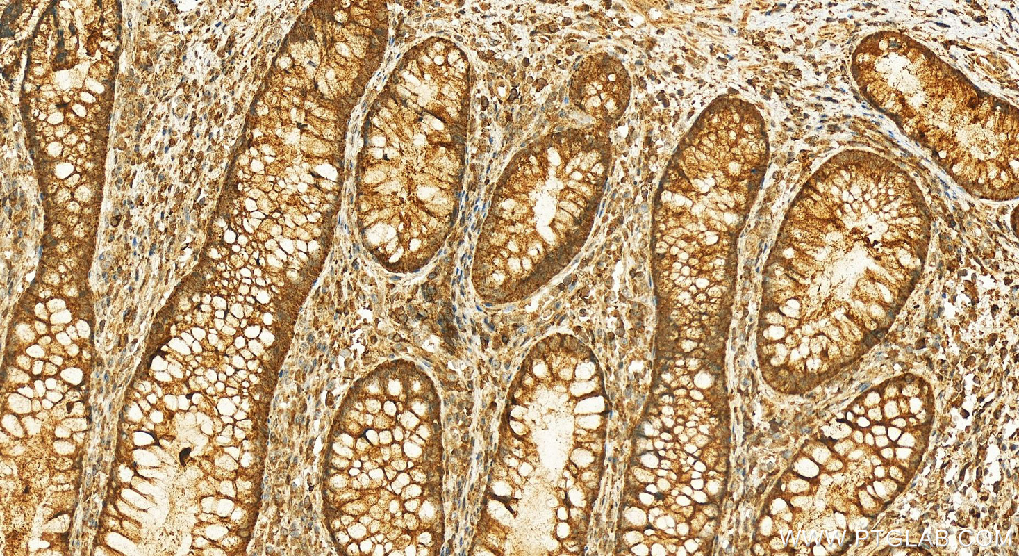 Immunohistochemistry (IHC) staining of human colon cancer tissue using C2orf79/PTRHD1 Polyclonal antibody (25576-1-AP)