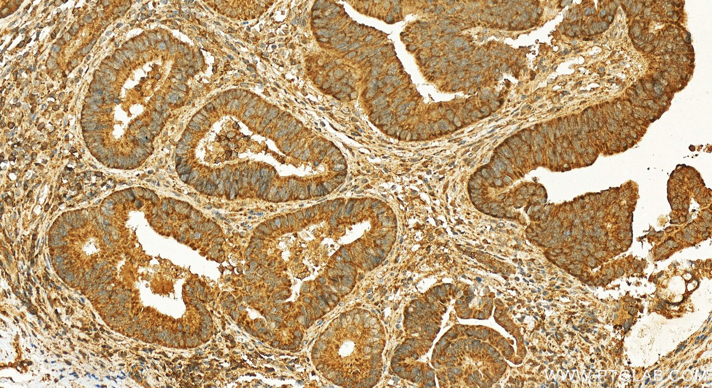 Immunohistochemistry (IHC) staining of human colon cancer tissue using C2orf79/PTRHD1 Polyclonal antibody (25576-1-AP)