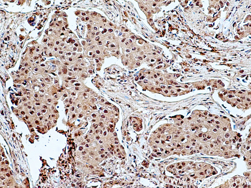 Immunohistochemistry (IHC) staining of human breast cancer tissue using C6orf211/ARMT1 Polyclonal antibody (25124-1-AP)