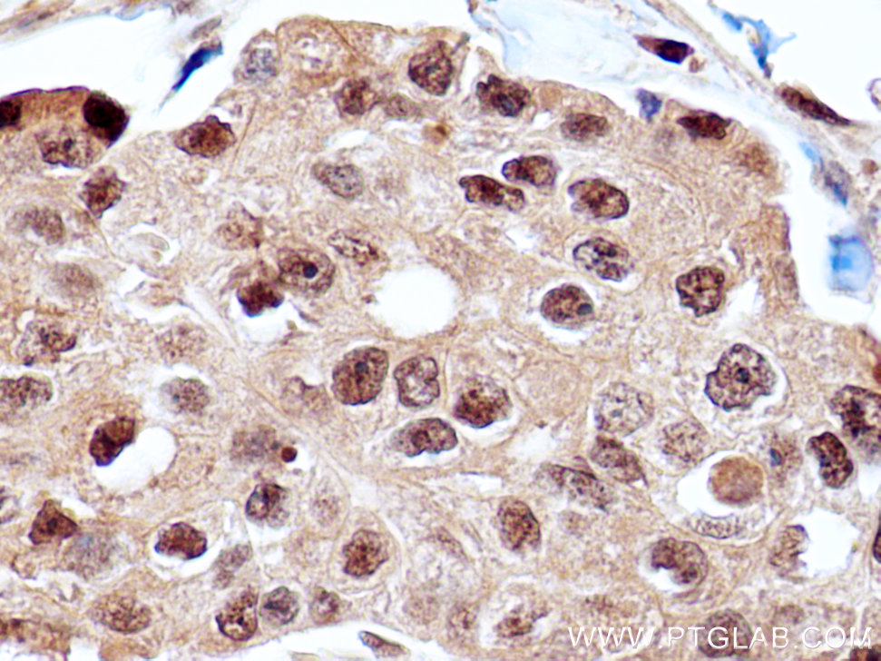 Immunohistochemistry (IHC) staining of human breast cancer tissue using C6orf211/ARMT1 Polyclonal antibody (25124-1-AP)