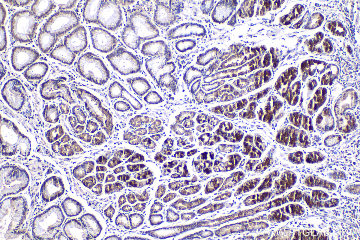 Immunohistochemistry (IHC) staining of human stomach cancer tissue using NGX6 Polyclonal antibody (21593-1-AP)