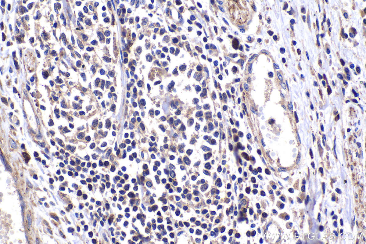 Immunohistochemistry (IHC) staining of human cervical cancer tissue using NGX6 Polyclonal antibody (21593-1-AP)