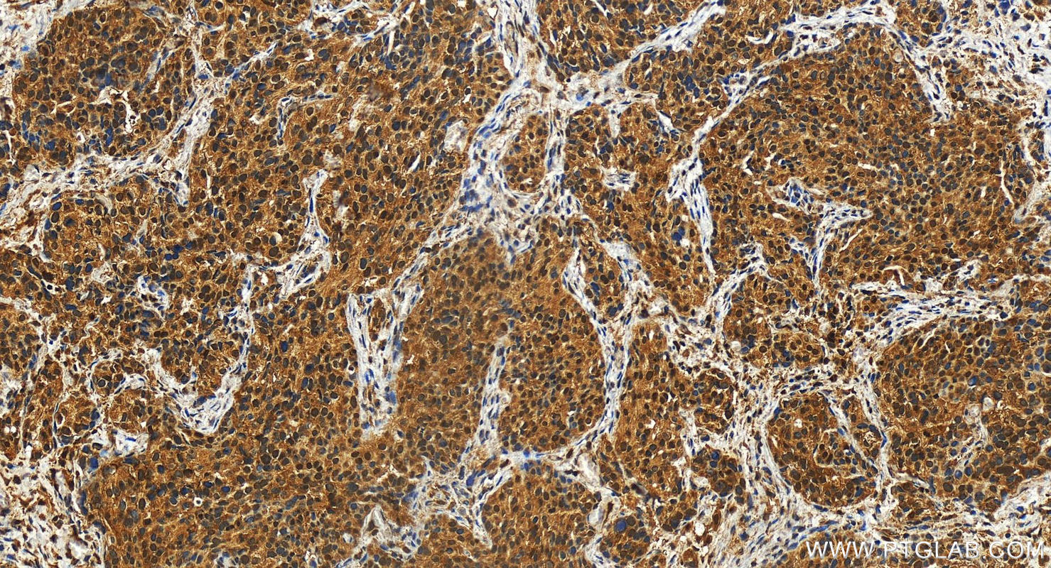 Immunohistochemistry (IHC) staining of human ovary cancer tissue using C9orf142 Polyclonal antibody (27134-1-AP)