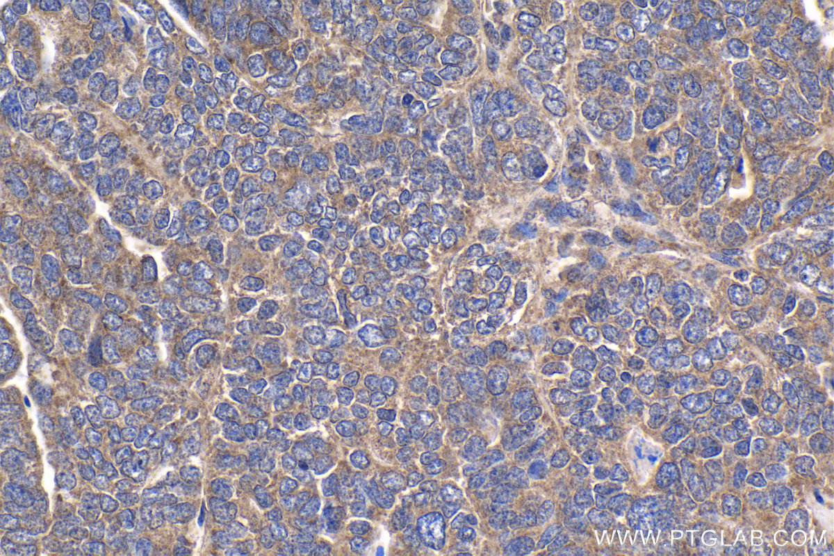 Immunohistochemistry (IHC) staining of human ovary tumor tissue using C9orf72 Polyclonal antibody (25757-1-AP)