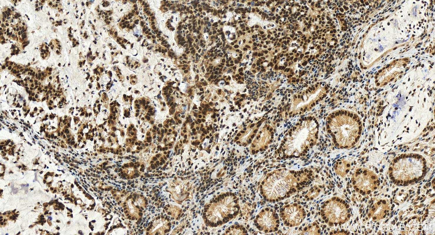 Immunohistochemistry (IHC) staining of human stomach cancer tissue using C9orf78 Polyclonal antibody (14496-1-AP)