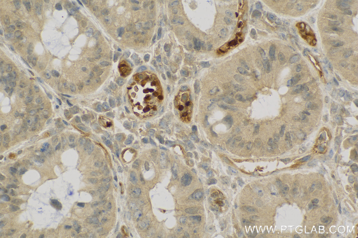 Immunohistochemistry (IHC) staining of human colon cancer tissue using CA1 Polyclonal antibody (13198-2-AP)