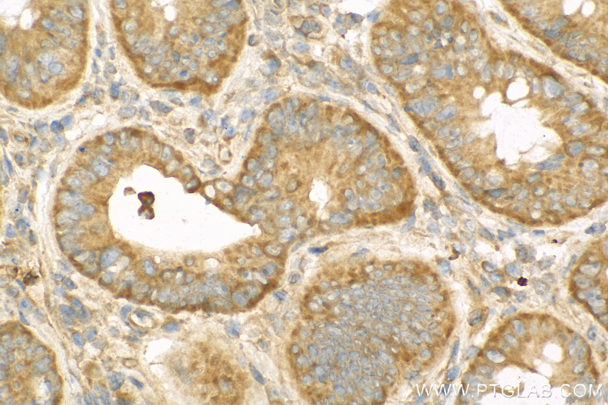 Immunohistochemistry (IHC) staining of human colon cancer tissue using CA4 Polyclonal antibody (13931-1-AP)