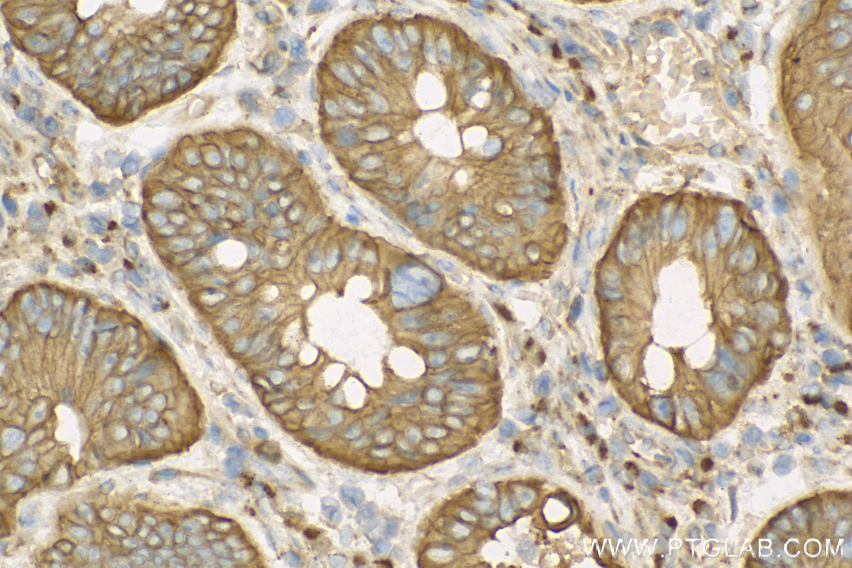 Immunohistochemistry (IHC) staining of human colon cancer tissue using CA4 Polyclonal antibody (13931-1-AP)