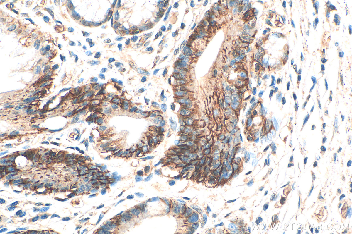 Immunohistochemistry (IHC) staining of human stomach cancer tissue using Carbonic Anhydrase IX/CA9 Polyclonal antibody (11071-1-AP)