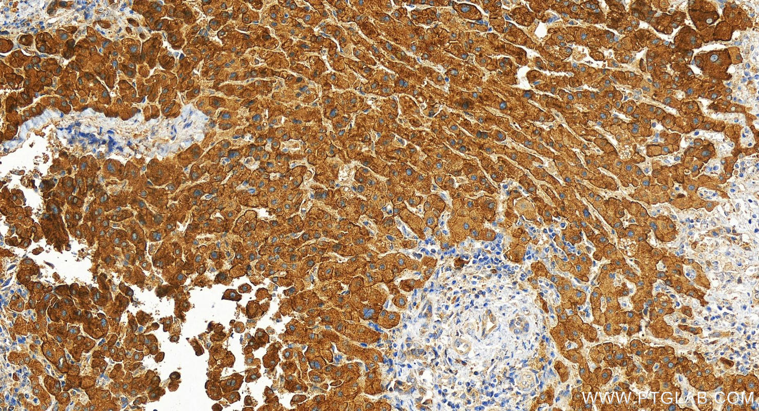 Immunohistochemistry (IHC) staining of human intrahepatic cholangiocarcinoma tissue using CADM1 Polyclonal antibody (14335-1-AP)