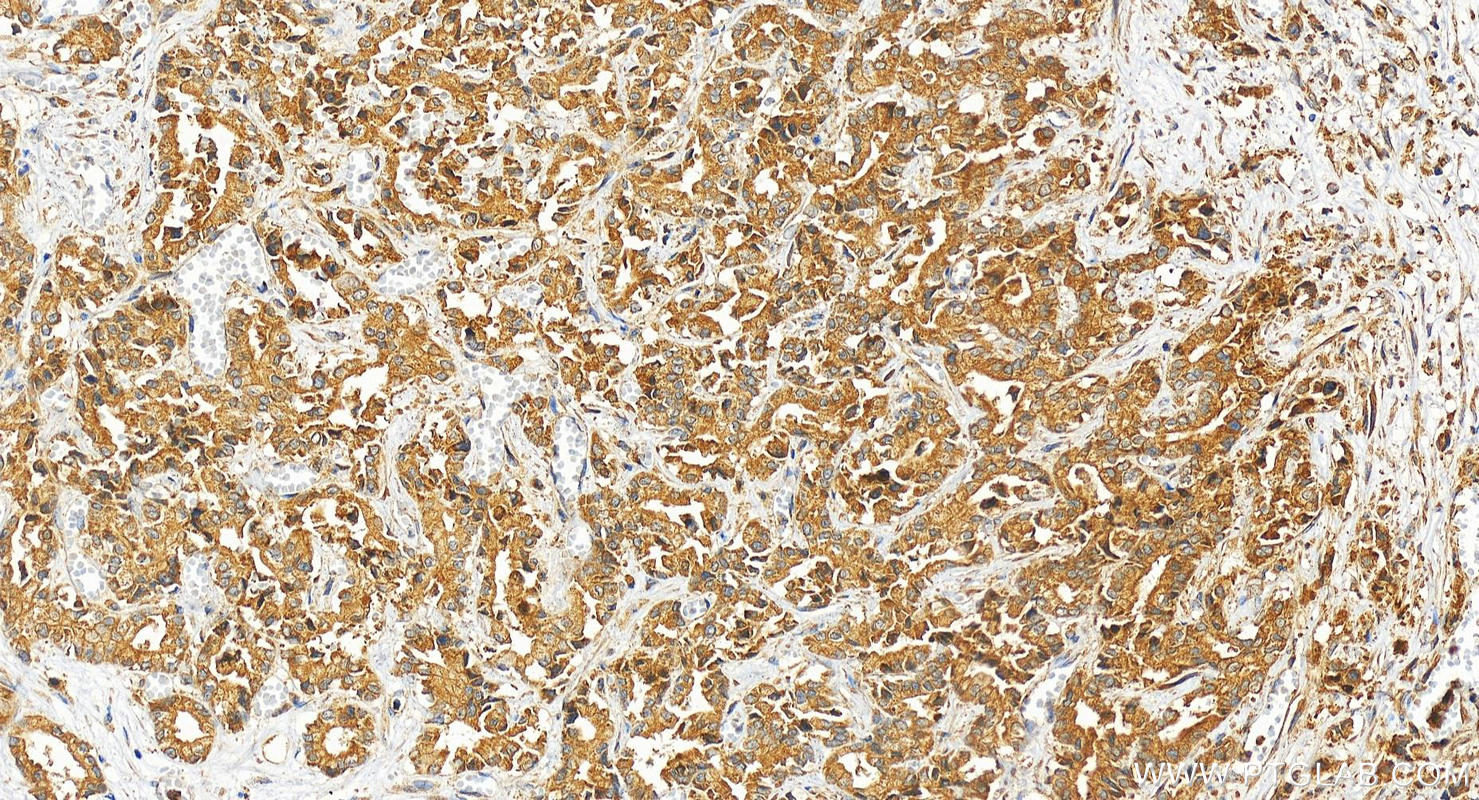 Immunohistochemistry (IHC) staining of human intrahepatic cholangiocarcinoma tissue using CADM1 Polyclonal antibody (14335-1-AP)