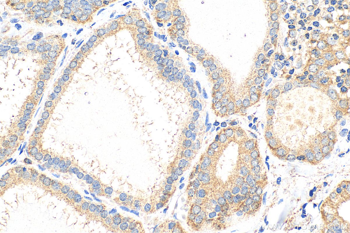 Immunohistochemistry (IHC) staining of human thyroid cancer tissue using CALCA/CGRP Monoclonal antibody (68774-1-Ig)
