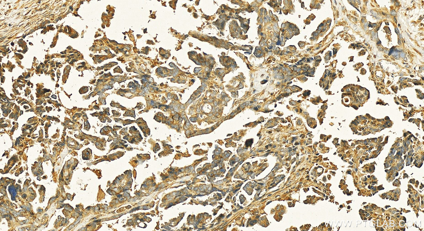 Immunohistochemistry (IHC) staining of human ovary cancer tissue using NDP52 Polyclonal antibody (12229-1-AP)