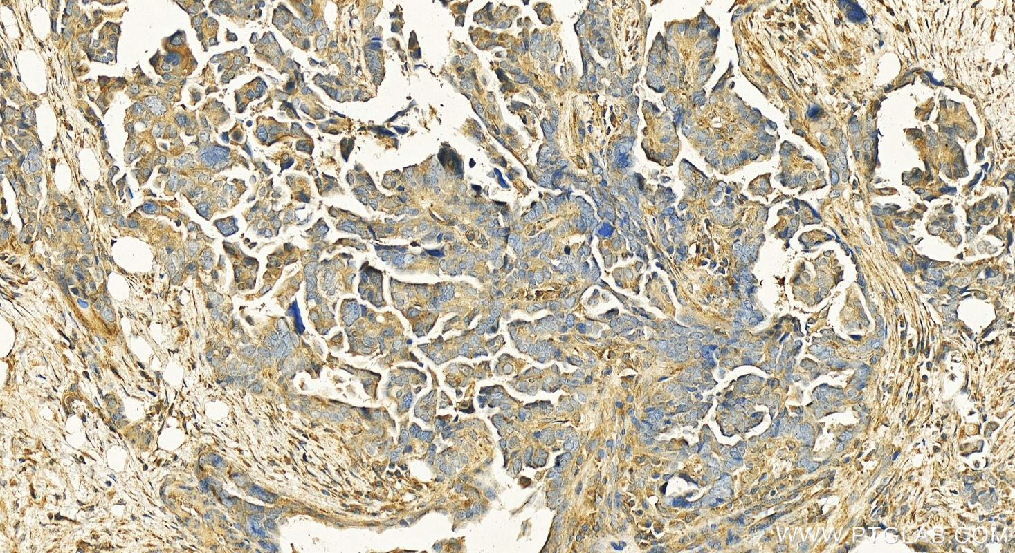 Immunohistochemistry (IHC) staining of human ovary cancer tissue using NDP52 Polyclonal antibody (12229-1-AP)