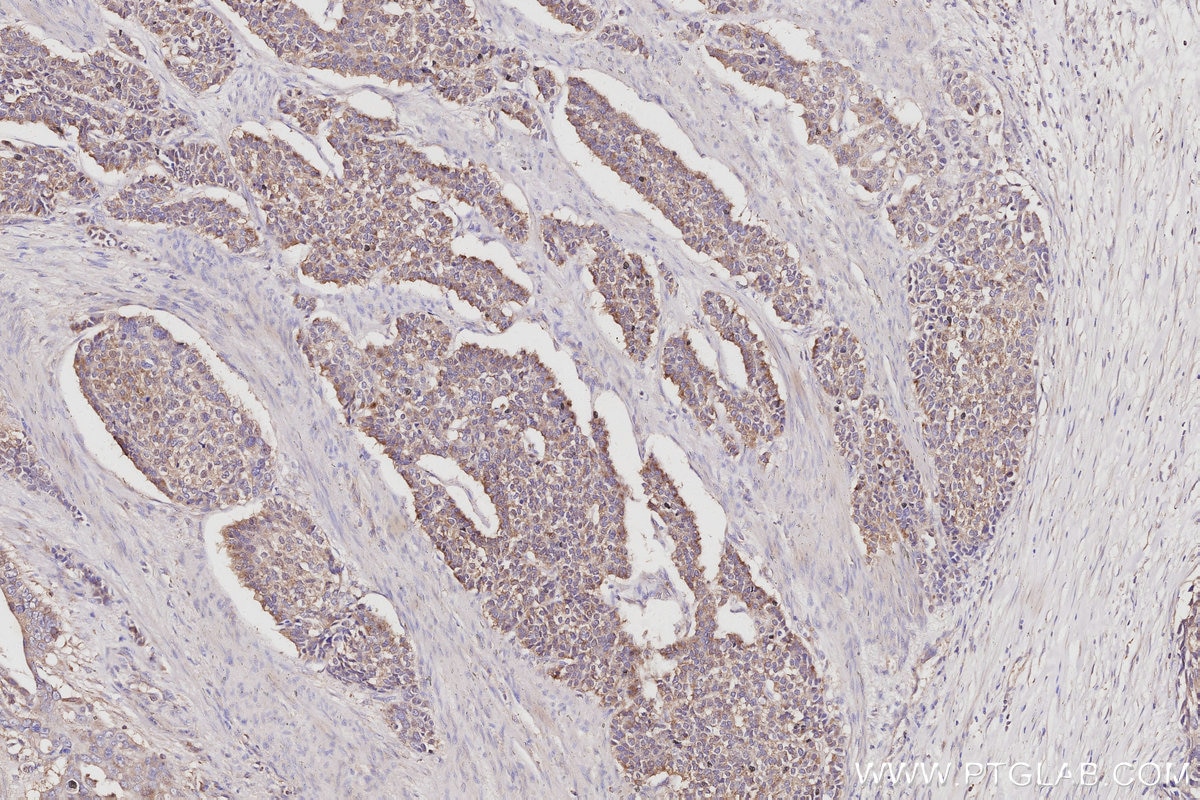 Immunohistochemistry (IHC) staining of human stomach cancer tissue using CaMK2 alpha Polyclonal antibody (13730-1-AP)